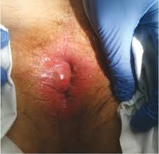 Image result for hemorrhoids
