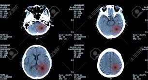 Brain tumors can occur at any age. Mri Scan Brain Ct Scan Of Brain Image For Diagnosis Hemorrhage Stock Photo Picture And Royalty Free Image Image 108200037