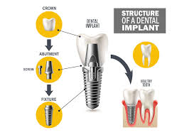 Image result for dental implant