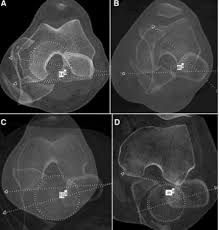 Image result for Femoral Retroversion