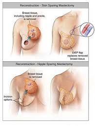 Skin Nipple Sparing Mastectomy Cancer Fighting Foods Skin Cancer Treatment Breast Cancer Awareness Lung Cancer