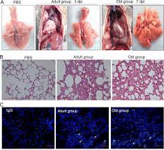 Top suggestions for lung tree. Characterization Of Lung Changes After Sars Cov 2 Infection In Chinese Download Scientific Diagram