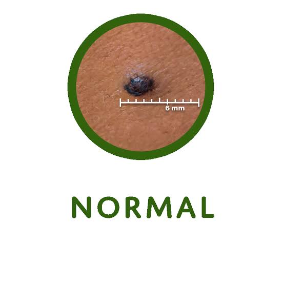 How to Check Your Moles for Skin Cancer - Prevent Cancer Foundation