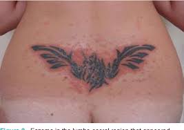 Getting a tattoo involves injecting colored ink under several layers of the skin using a tiny needle. Figure 2 From Allergic Contact Dermatitis To Hydrocortisone As A Complication Of Tattoo Care Semantic Scholar