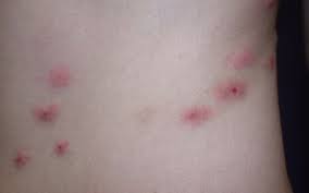 Image result for wolf spider bite skin