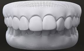 How does an overbite look like. How Long Does Invisalign Take Crosby Dental Liverpool