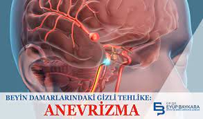Beyin Damarlarindaki Gizli Tehlike Anevrizma