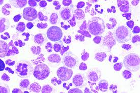 Aplasie der roten blutkörperchen, prca) ist eine erworbene anämie, die durch die zerstörung oder fehlende. Pure Red Cell Aplasia Hematomorphology A Databank Imagebank For Hematology Blood And Bone Marrow Examination