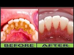 How To Clean Yellow Teeth Naturally And Remove Dental Plaque Without Tooth Paste In 2 Minutes Youtu In 2020 Dental Plaque Cleaning Teeth Plaque Teeth Cleaning Plaque