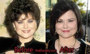 Her appearance looks weird after having some beauty surgeries done. Delta Burke Plastic Surgery Before And After Facelift Botox Pictures