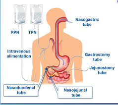 Parenteral Enteral Nutrition Tube Feeding Types Of Nonoral Feeding Outlined From Amy Speech And Language T Nursing Mnemonics Dysphagia Therapy Nursing Tips