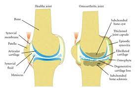 Healthy On Left And Osteoarthritic Joints 1 Joint Components Such As Articular Cartilage Subchondral Bone And Synovi Synovial Joint Healthy Joints Joint