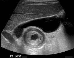 Stomach Gastric Duplication Cyst An Ultrasound Image Of The Upper Mid Abdomen Along The Long Axis Of Th Ultrasound Sonography Medical Ultrasound Ultrasound