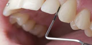 Bakterien Versteckte Brandherde In Der Mundhohle Myzahnarzt Com