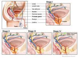 Prostate cancer starts in the prostate gland. Enlarged Prostate Prostate Cancer Treatment Hospital India