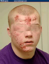 Connect with friends, family and other people you know. Herpes Gladiatorum Full Contact Infectious Diseases Discover Magazine