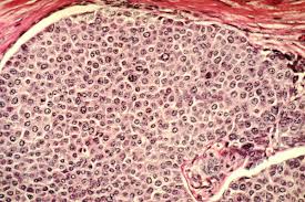 Cancer cells, however, have the ability to grow without these external signals. Cancer Cell Wikipedia