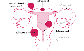 Uterine Fibroids Myovant Sciences