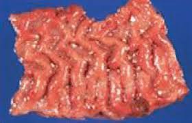 Image result for Intestinal Enteropathy
