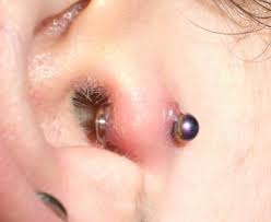 The time needed for the perforation to heal may vary significantly. Infected Tragus Piercing Signs Bump Inflammation Swollen How To Clean And Healing Lightskincure Infected Tragus Piercing Tragus Piercings Tragus