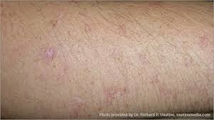 Whites are much more likely to be affected by this skin cancer than are blacks. Skin Cancer Pictures Photos Pictures Of Skin Cancer