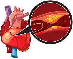 The coronary arteries wrap around the entire heart. Coronary Artery Disease Treatment Causes Prevention Methods
