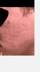 And be gentle if you're shaving affected skin. Facial Hair Chin Face Cheek Forehead Acne People Human Back Lip Png Pngwing