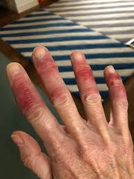 Image result for Chilblains
