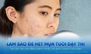 Làm sao để hết mụn tuổi dậy thì? Tất tần tật mọi điều cần biết