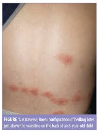 Live bed bugs hide and are not usually seen. Atypical Linear Configuration Of Bedbug Bites In An Eight Year Old Boy A Case Report And Overview Of Cimicosis Jcad The Journal Of Clinical And Aesthetic Dermatology