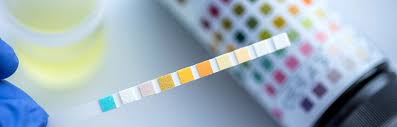 Zucker Im Urin Haufige Ursachen Und Testinfos Diabetes Help