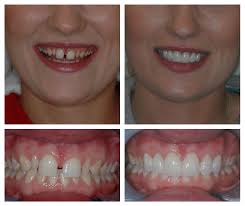 How long do dental veneers last. Dental Veneers Surrey Chipped Broken Teeth Treatment