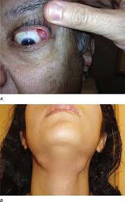 Image result for Relapsing Polychondritis