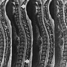 Pdf Brain And Spinal Cord Abnormalities In Multiple Sclerosis Correlation Between Mri Parameters Clinical Subtypes And Symptoms