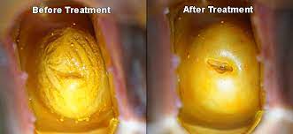 Escharotic Therapy Brannick Clinic Of Natural Medicine