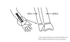 Broke my wrist twice but it never looked like a subway sandwich. Kids Health Information Fracture Care Wrist