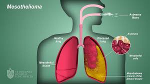 mesothelioma cancer is a disease that results from exposure to asbestos related substances. Mesothelioma St Vincent S Lung Health