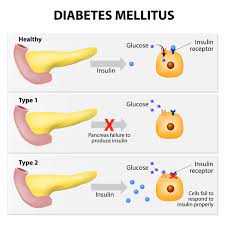 We do not know what causes type 2 diabetes. Type 2 Diabetes Medlineplus Genetics