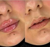 Lip filler 💋 Hymax Swiss