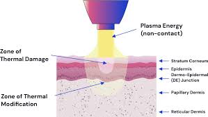 Box 188 coleraine, minnesota 55722 submitted by: Plasma Skin Regeneration Technology Neogen Plasma