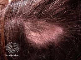 Et kjerringråd mot flass er følgende: Hartap Store Medisinske Leksikon