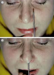 A spreader graft is made of cartilage and is inserted between the dorsal (upper) septum and the upper lateral cartilage to widen the internal nasal. Endonasal Spreader Graft Placement As Treatment For Internal Nasal Valve Insufficiency No Need To Divide The Upper Lateral Cartilages From The Septum Archives Of Facial Plastic Surgery Vol 6 No 1