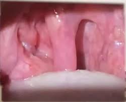 Image result for Uvulitis