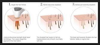 Almost all of the reviews talk about the tria 4x's effectiveness. Pin On Hair Removal Facial