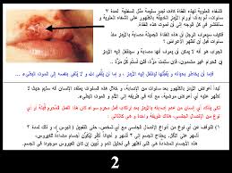 صور عن مرض الايدز