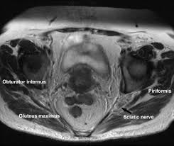A variably thick muscular membrane called a diaphragm coccygeus and levator ani muscles the lower part of the this mri male pelvis axial cross sectional anatomy tool is absolutely free to use. Pelvic Anatomy And Mri Sciencedirect