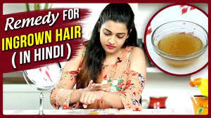 It can happen naturally or it can happen because of shaving, waxing or using any methods of pubic hair removal. Ingrown Hair Removal At Home Remedy For Ingrown Hair In Hindi Diy Ingrown Hair Treatment Youtube