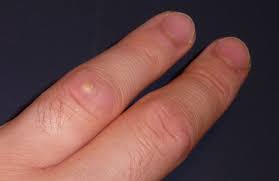Et toute contrefaçon est un délit. Bouton Inflammation Sur Le Doigt Acne Psoriasis Et Problemes De Peau Forum Sante Doctissimo