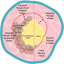 Outcome data we extracted the epidemiological history (i.e., clear contact history and unclear contact. An Update On Surgical Margins In The Head Neck Squamous Cell Carcinoma Assessment Clinical Outcome And Future Directions Springerlink