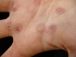 Overuse, injury, and many other causes can result in groin pain. Friction Blister Dermnet Nz